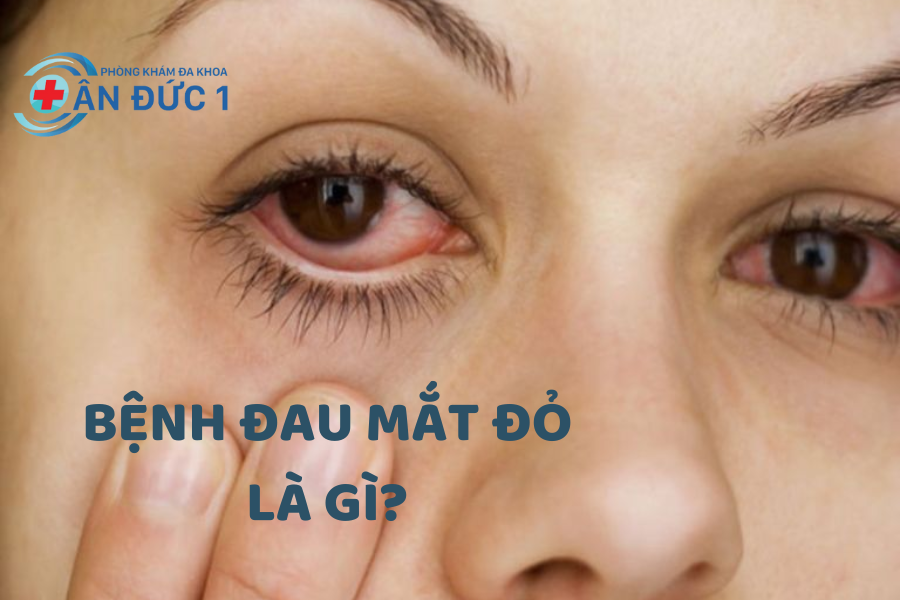 BỆNH ĐAU MẮT ĐỎ LÀ GÌ