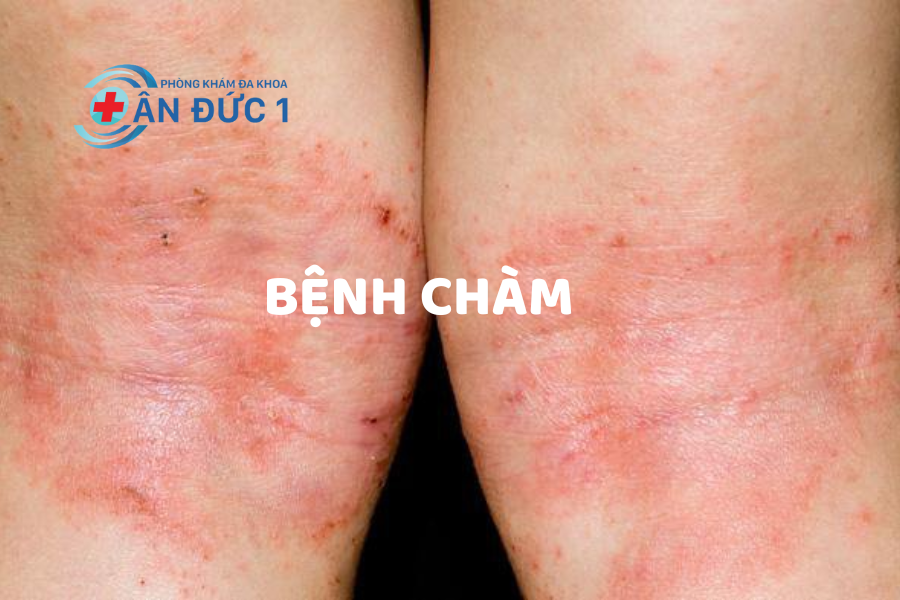 Bệnh chàm
