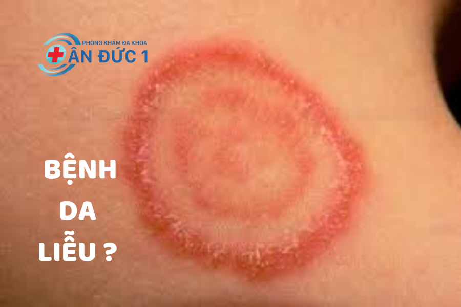 Bệnh da liễu