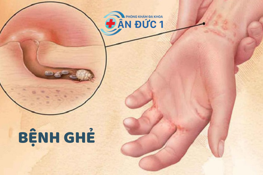 Bệnh ghẻ