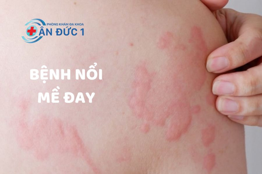 Bệnh nổi mề đay