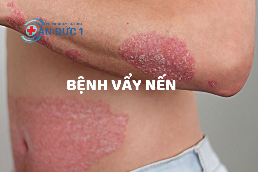 Bệnh vẩy nến