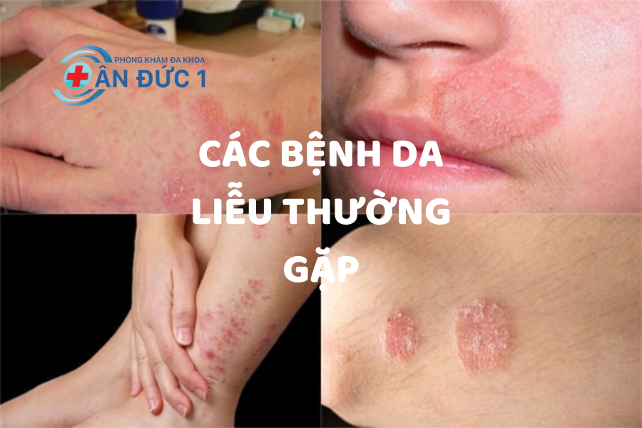 BỆNH DA LIỄU THƯỜNG GẶP TRONG CUỘC SỐNG