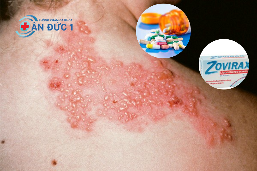 Điều trị bệnh zona thần kinh