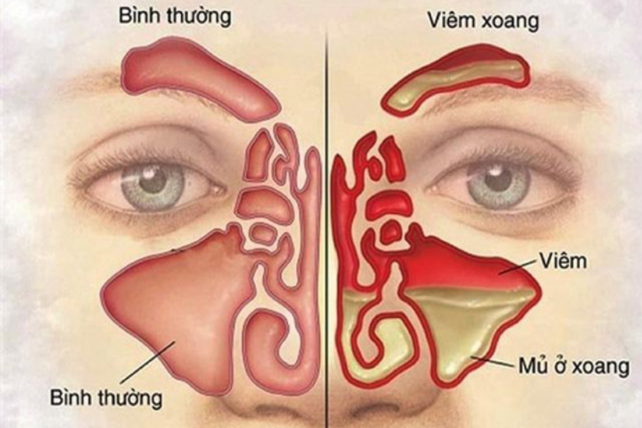 Viêm mũi xoang