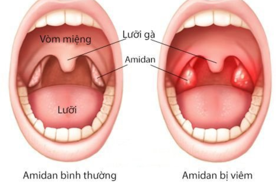 Bệnh tai mũi họng thường gặp
