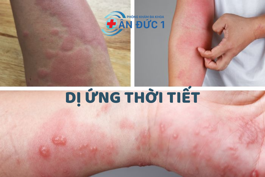 Dị ứng thời tiết