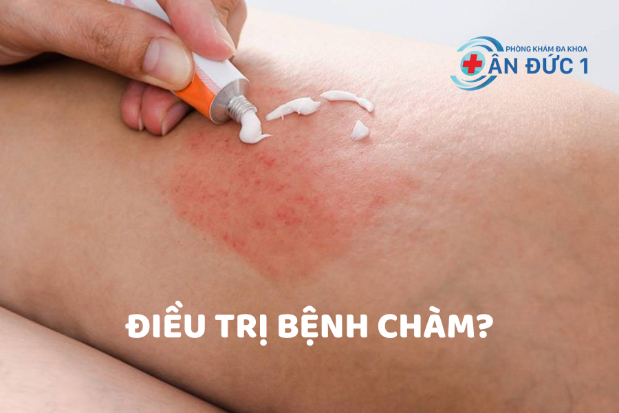 Điều trị bệnh chàm hiệu quả.