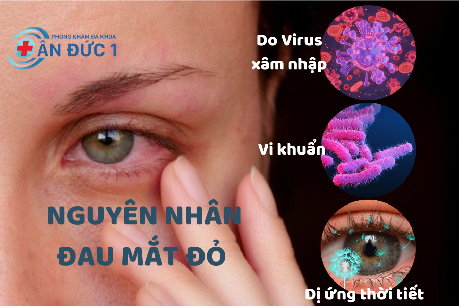 NGUYÊN NHÂN GÂY BỆNH ĐAU MẮT ĐỎ
