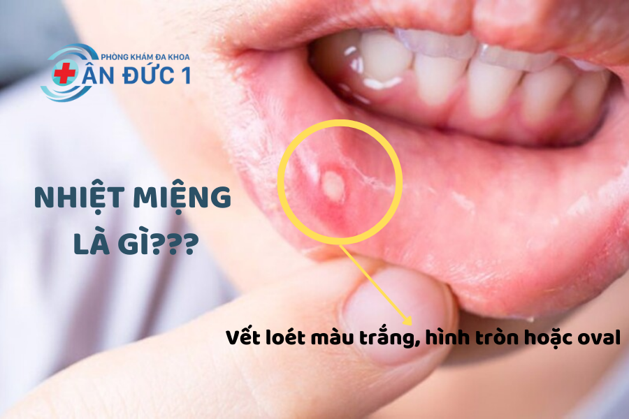 Nhiệt miệng là gì?