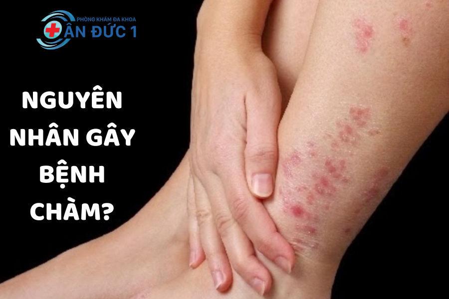 Nguyên nhân gây bệnh chàm