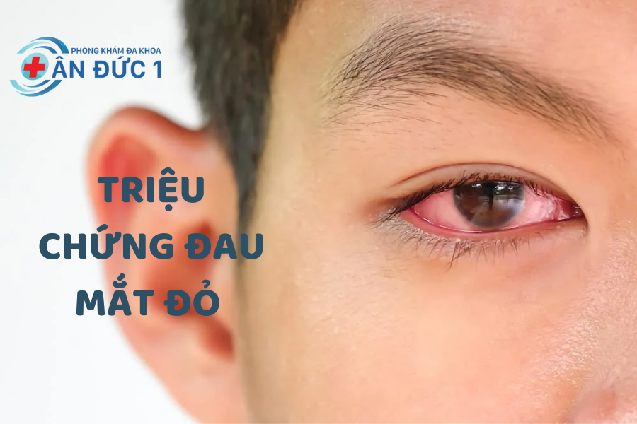 Triệu chứng của bệnh đau mắt đỏ