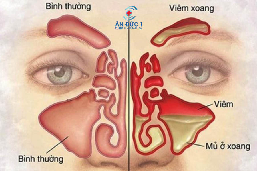 phòng tránh bệnh tai mũi họng
