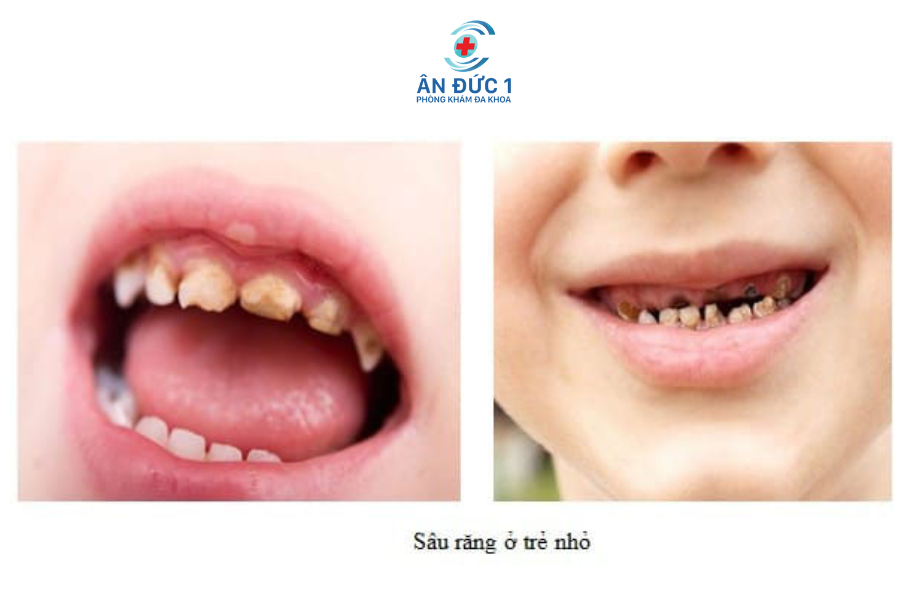 Bệnh răng miệng thường gặp