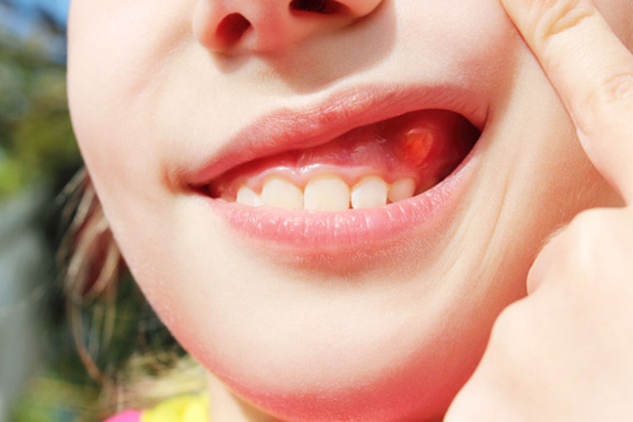 Bệnh răng miệng thường gặp