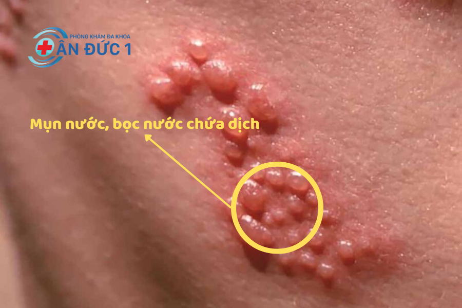 Triệu chứng của bệnh zona