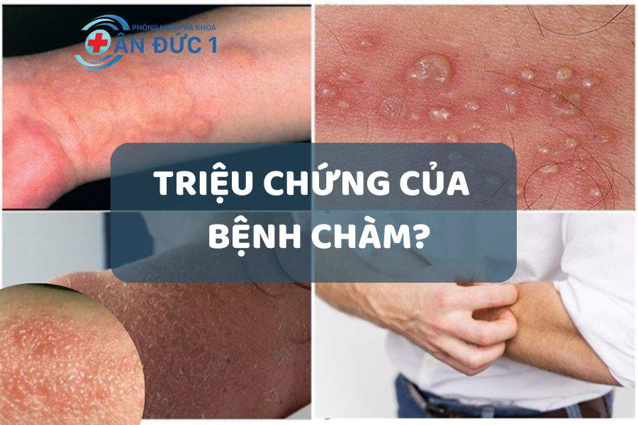 Triệu chứng của bệnh chàm