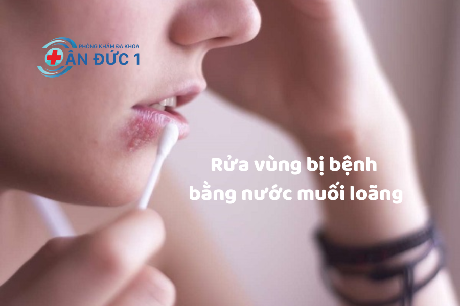 Vệ sinh sạch sẽ vùng bị bệnh