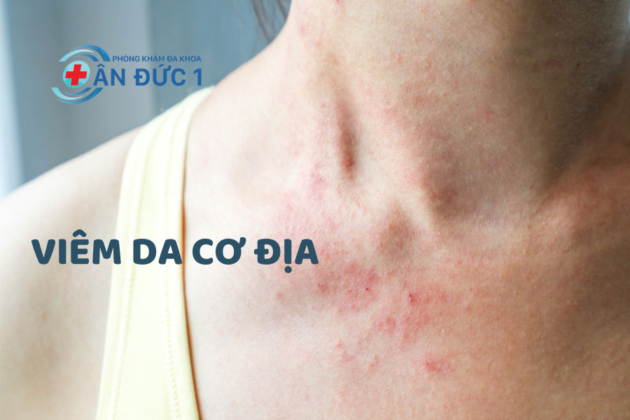 Viêm da cơ địa