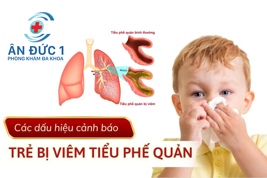 Viêm tiểu phế quản