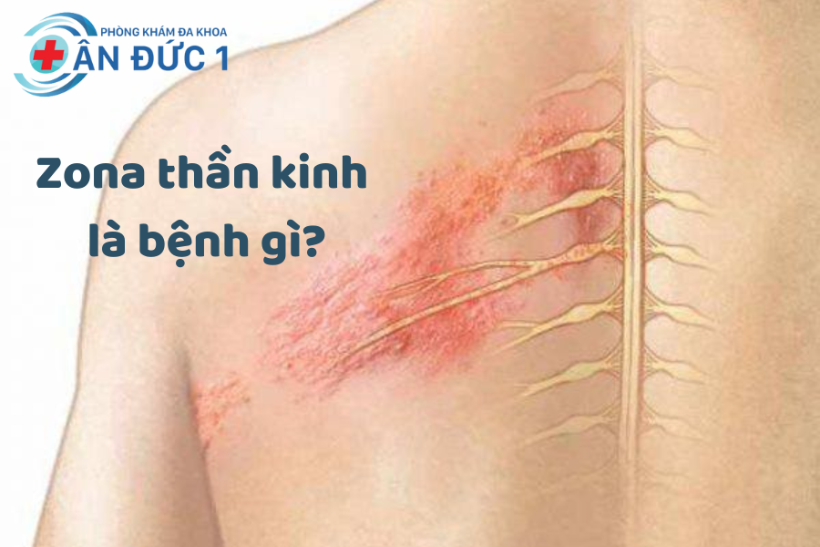 Zona thần kinh là bệnh gì