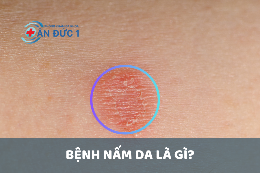 Bệnh nấm da là gì?
