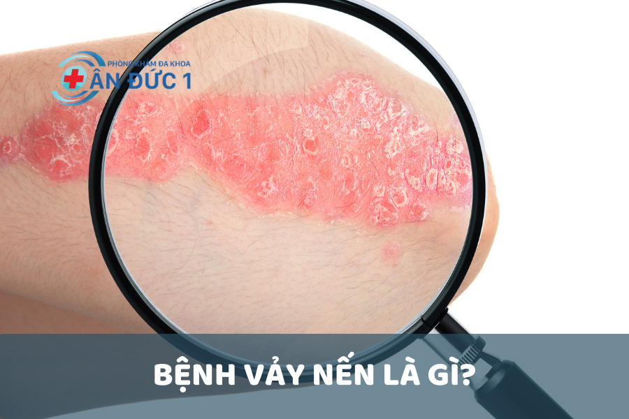 Bệnh vảy nến là gì?