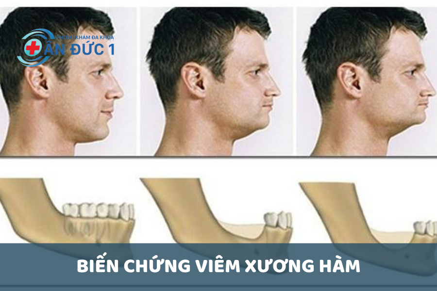Biến chứng của viêm xương hàm