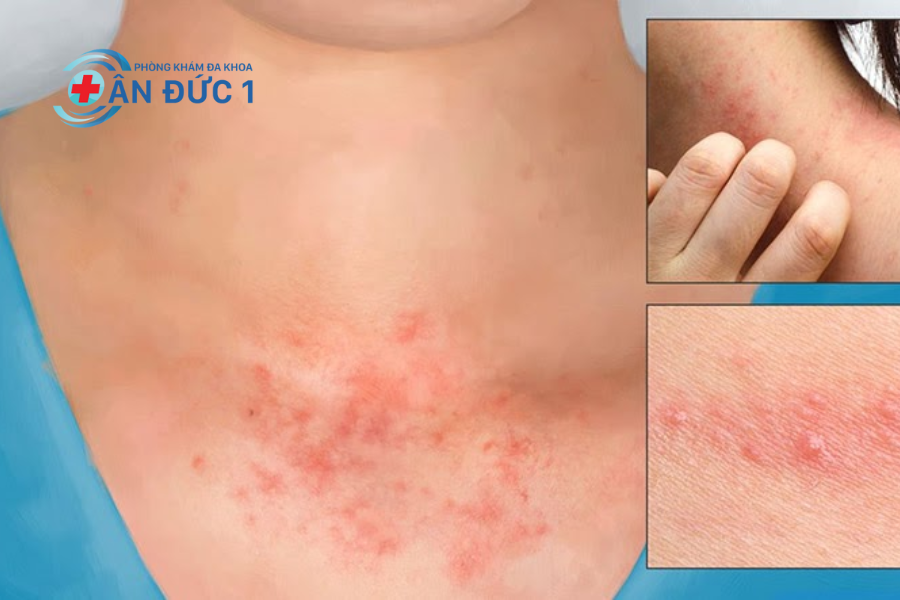 Dấu hiệu của bệnh