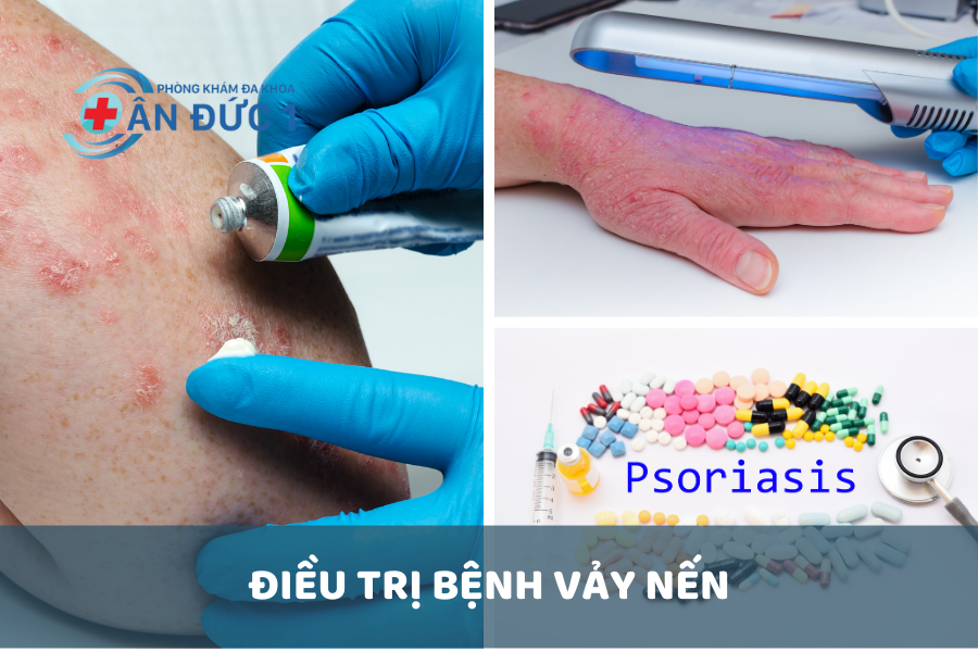 Điều trị bệnh vảy nến
