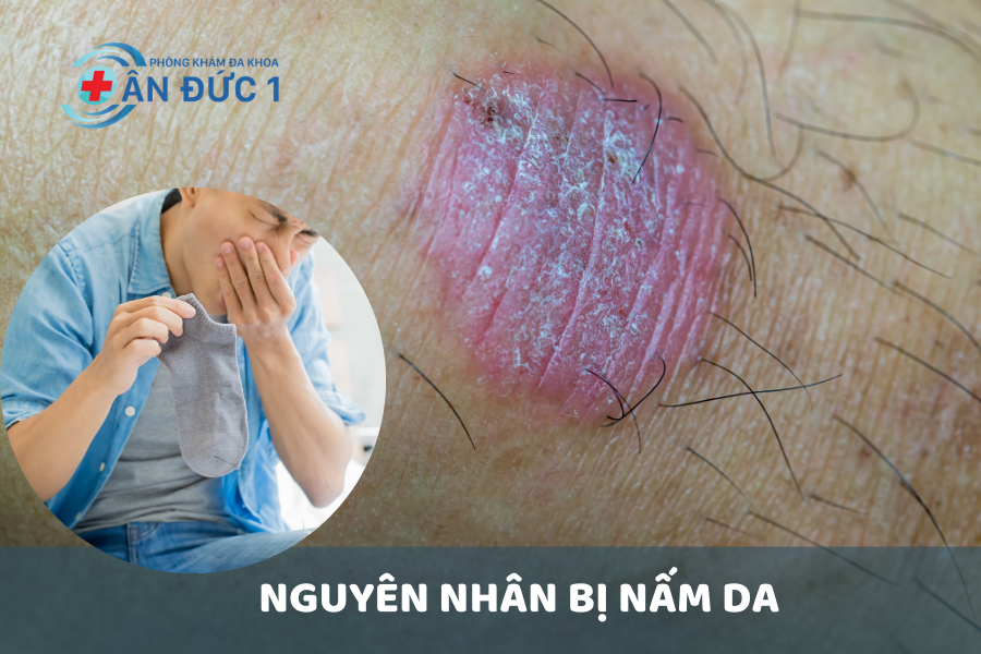 Nguyên nhân bị nấm da