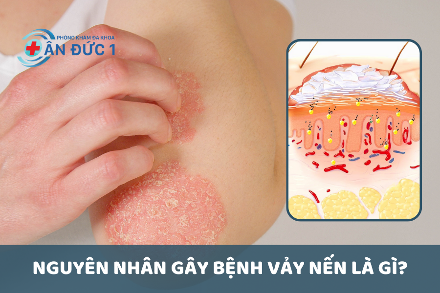 Nguyên nhân gây bệnh vảy nến