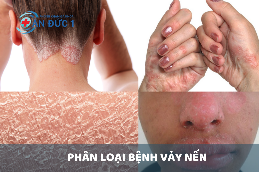 Phân loại bệnh vảy nến