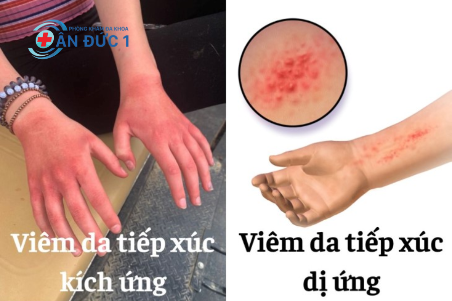 Phân loại và triệu chứng của VDTX
