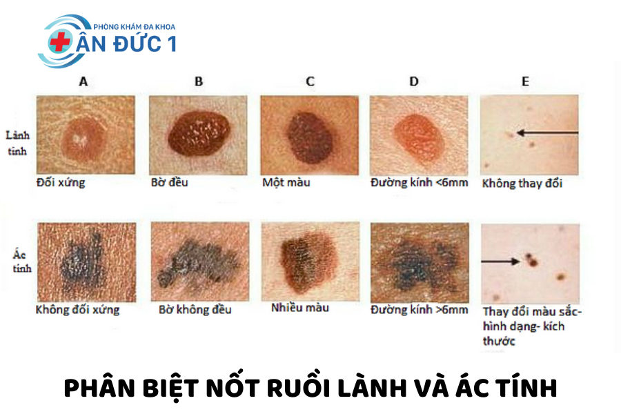 Sự khác nhau giữ nốt ruồi lành tính vá ác tính