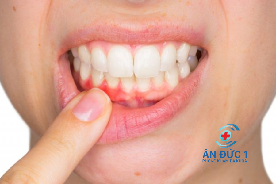 bệnh vè răng miệng