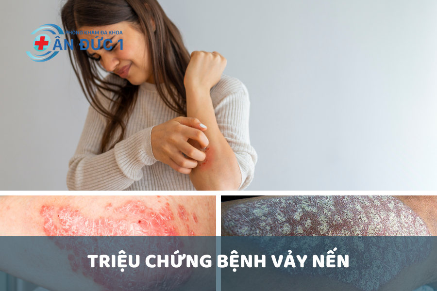 Triệu chứng bệnh vảy nến