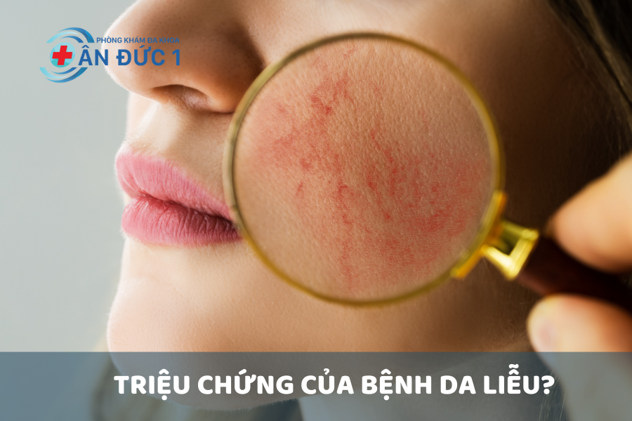 Triệu chứng của bệnh da liễu