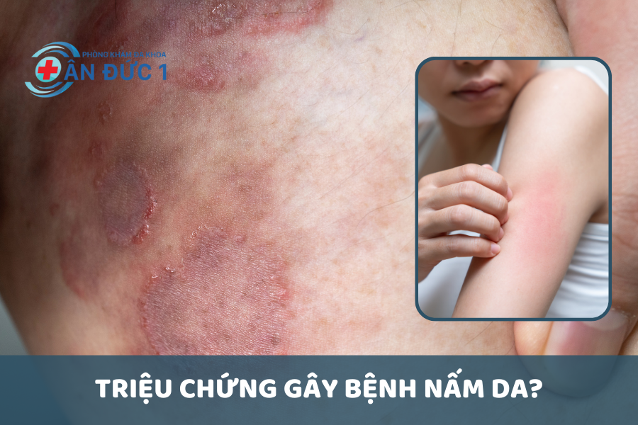 Triệu chứng của bệnh