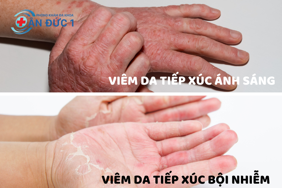 Viêm da tiếp xúc ánh sáng và bội nhiễm