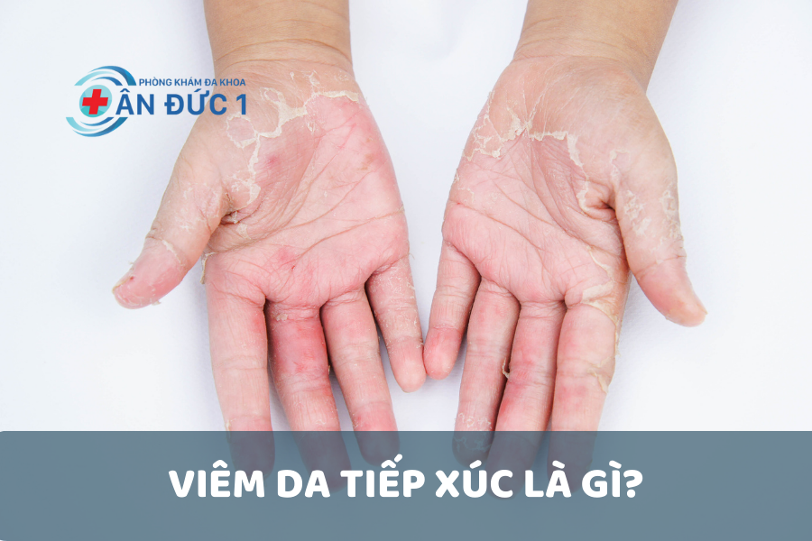 Viêm da tiếp xúc là gì?