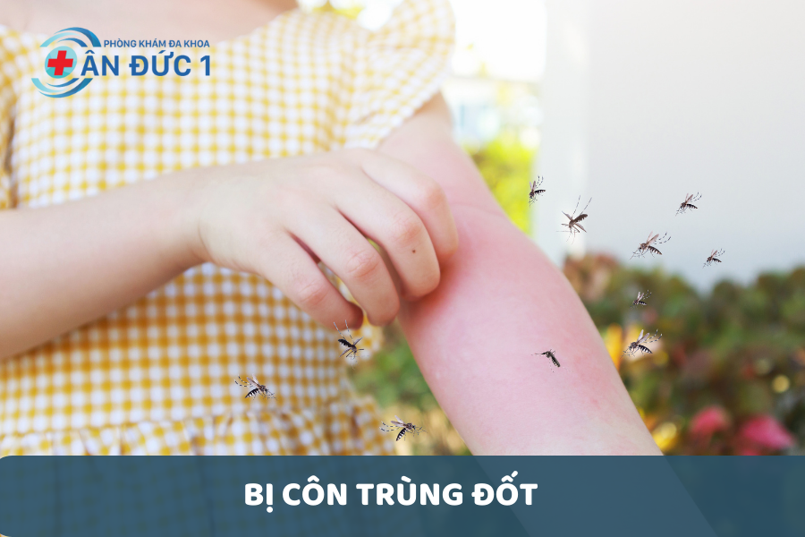 Bị côn trùng đốt